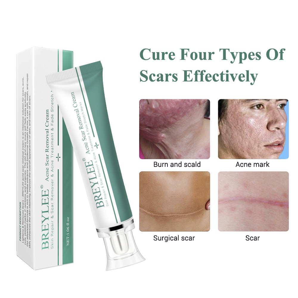 Removal Scar Cream Face Pimples Scar Stretch Marks Removal Acne Treatment Whitening Moisturizing Cream Skin Care