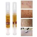 5ml Ultra Strength Skin Tag Remover 12 hours Tu kill Medical Tu kill Remover Foot Corn Skin Tag Mole & Genital Wart Remover