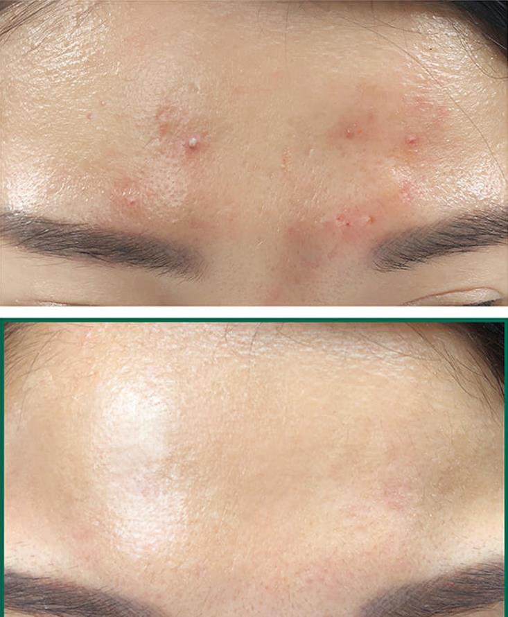 SOME BY MI AHA BHA PHA 30 Days Miracle Toner 150ml SomeByMi Facial Toner Serum Blackheads Remove Acne Treatment Skin Exfoliating