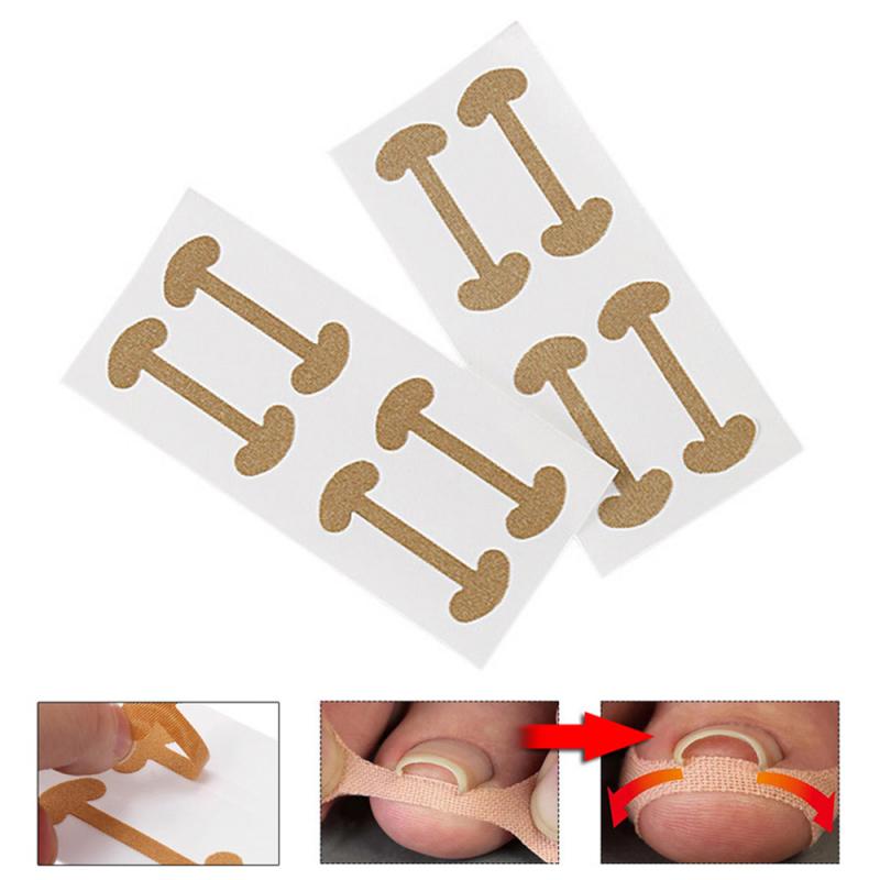 4pcs Effiective Toe Nail Corrector Deformation Meat Bag Ingrown Toenail Tool Orthodontic Thumb Nail Roll Patch Foot Care Device
